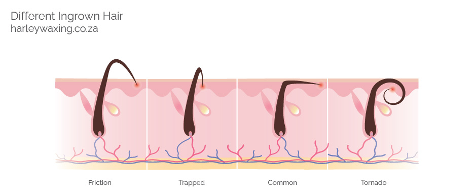 Diagram Showing Four Different Types of Ingrown Hair